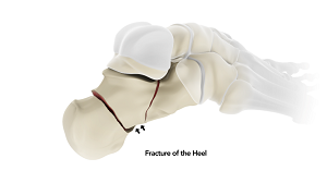 fracture of the heel