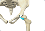 Developmental Dislocation (dysplasia) of the Hip