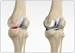 Non-surgical treatments for osteoarthritis of the knee