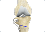 Osteotomy and uni-compartmental knee arthroplasty